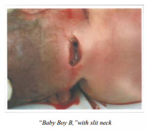 baby-boy-b-with-slit-neck